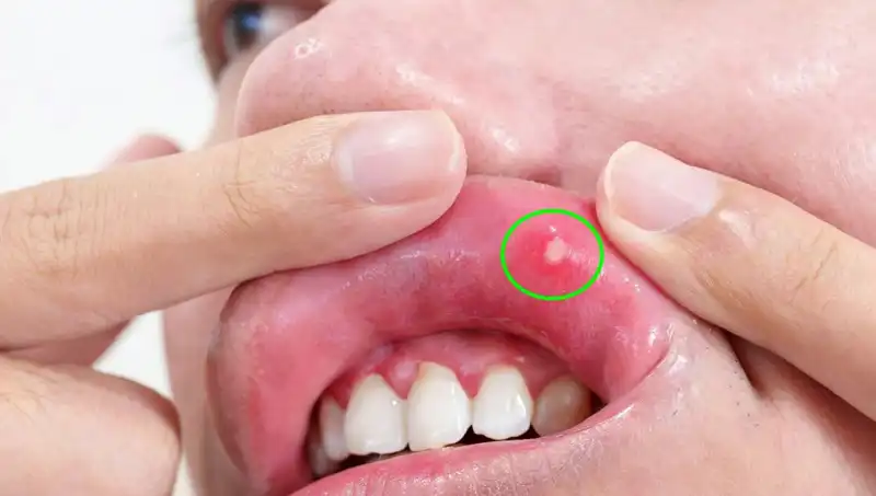 Kanser Belirtilerini İhmal Eden Hasta, Dilini Kaybetme Riskiyle Karşılaştı